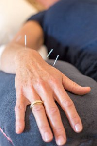 Akupunktur